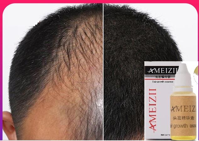 Japanese Hair Growth Serum 100% Pure Natural For Hair Loss Treatment Prevents Hair Loss - Ameizii 20ml